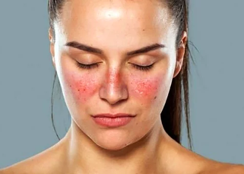 Sistemik Lupus Erİtematozus (SLE) Sistemik Lupus Erİtematozus (SLE)