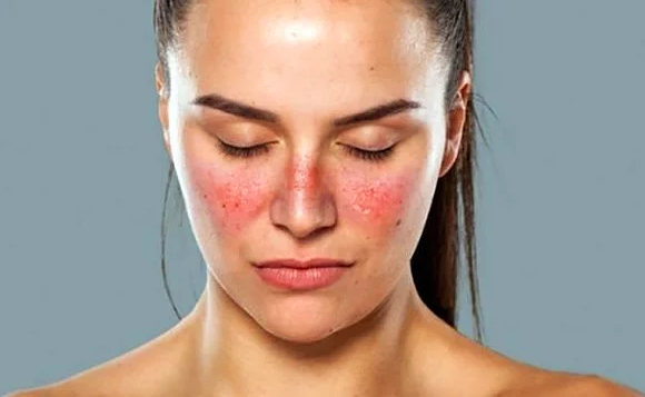 Sistemik Lupus Erİtematozus (SLE) Sistemik Lupus Erİtematozus (SLE)