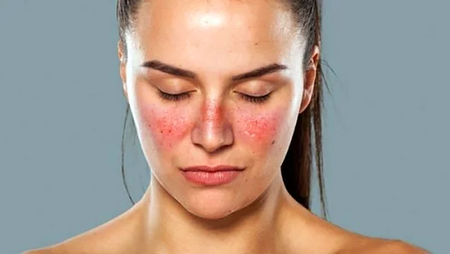 lupus1 Sistemik Lupus Erİtematozus (SLE)