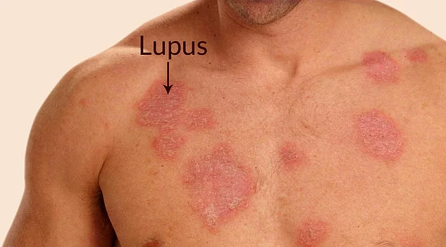 lupus2 Sistemik Lupus Erİtematozus (SLE)