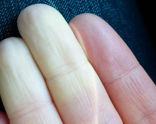 Raynaud Hastalığı nedir? Raynaud Hastalığı nedir?