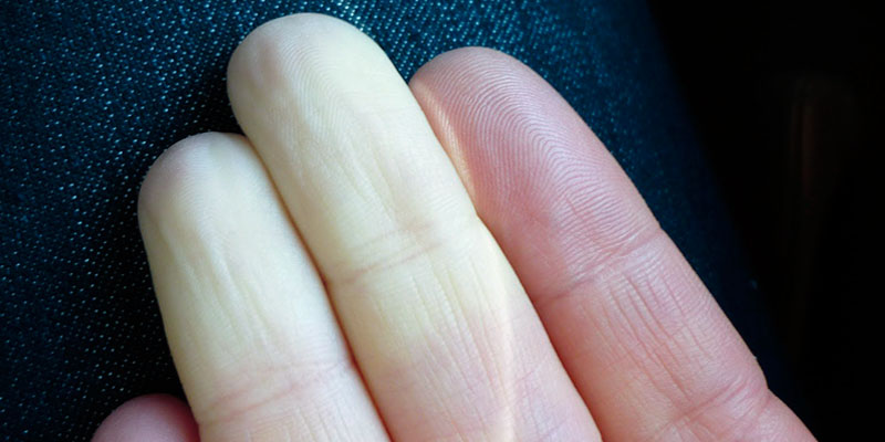 Raynaud Hastalığı nedir? Raynaud Hastalığı nedir?