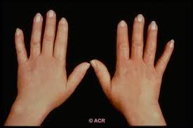 Sklroderma nedir ? Sklroderma nedir ?